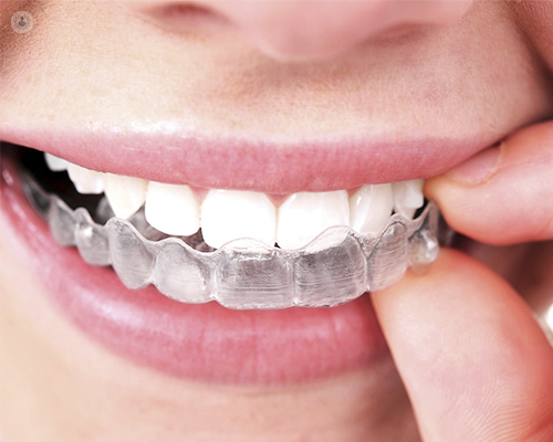 Invisalign: ¿Cómo funciona y cuánto tiempo se tarda en obtener una sonrisa  perfecta? - Clínica Dental Pradillo