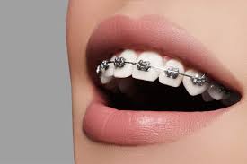 promedio de un tratamiento de ortodoncia