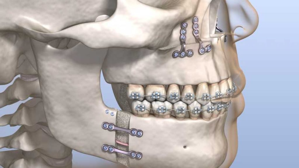 cirug-a-ortogn-tica-en-m-xico-la-soluci-n-para-problemas-de-mordida-y